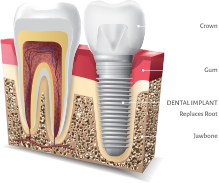 dental implant illustration