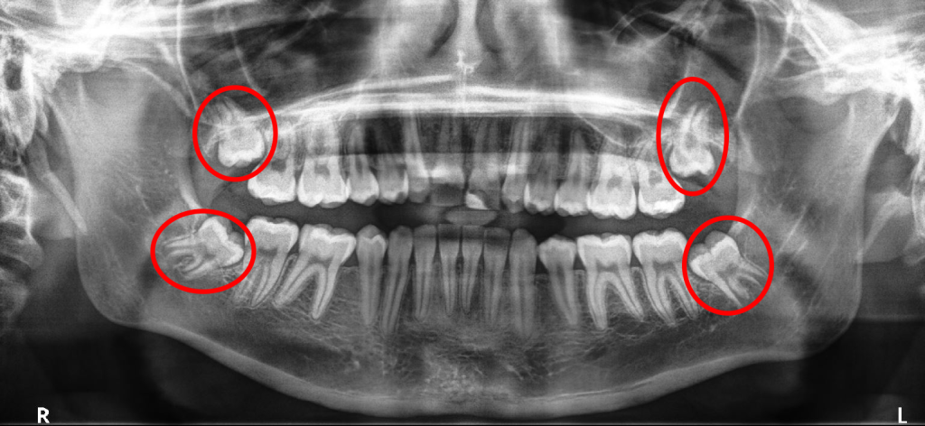 wisdom teeth X-ray